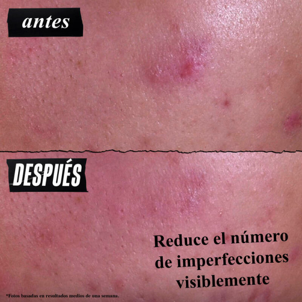 gently-effective-blemish-targeting-akne-reinigungsbehandlung