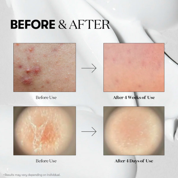 mild-reedle-shot-50-serum-for-smoother-more-radiant-skin