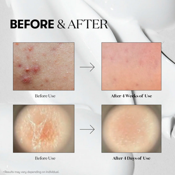 reedle-shot-100-trattamento-di-microneedling-effetto-luminoso