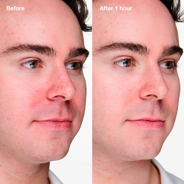 anti-blemish-solutions-clinical-gel-anti-imperfezioni-avanzato