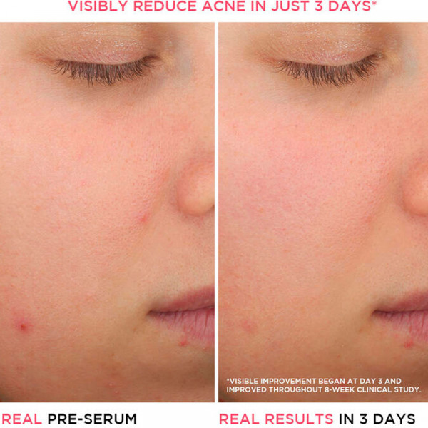 bye-bye-breakout-salicylzuurserum